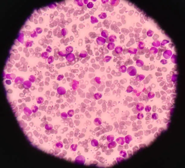Wright–Giemsa smear at 100x